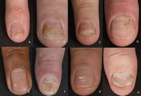 Nail Psoriasis A Review Of Treatment Options Springerlink