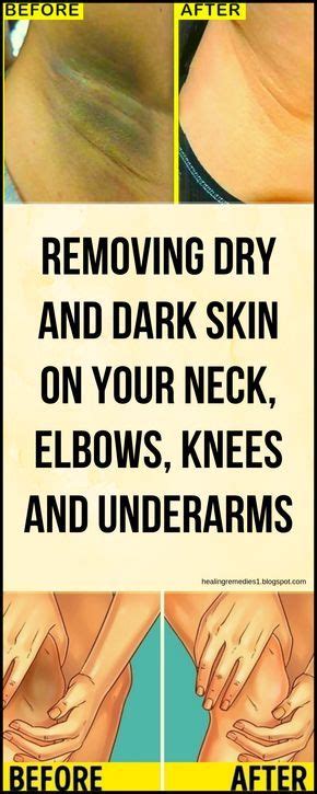 Removing Dry And Dark Skin On Your Neck Elbows Knees And Underarms