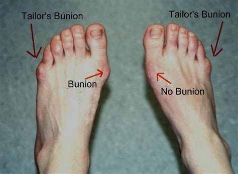 Tailors Bunion Causes Symptoms Treatment Prognosis And Prevention