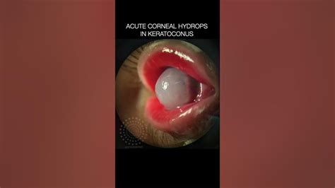 Acute Corneal Hydrops In Keratoconus Hidropsia Youtube