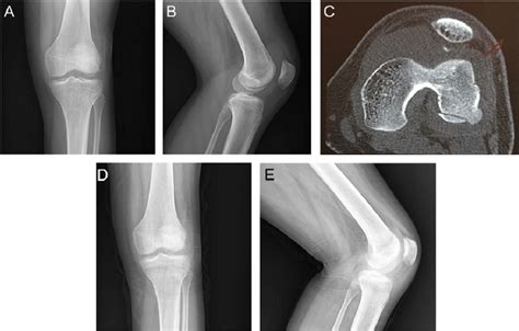 Femoral Condyle Insufficiency Fracture