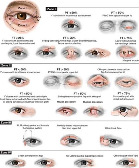 RECONSTRUCTION OF THE EYELIDS CORRECTION OF PTOSIS AND CANTHOPLASTY