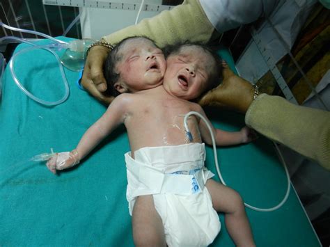 Female Baby Having Two Heads Born In India Huffpost