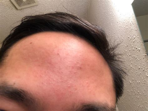 Forehead Bumps Will Not Go Away Affecting Confidence For Work Over The Counter Acne
