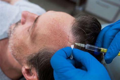 How To Treat Temple Hair Loss Dermatologist In Roorkee