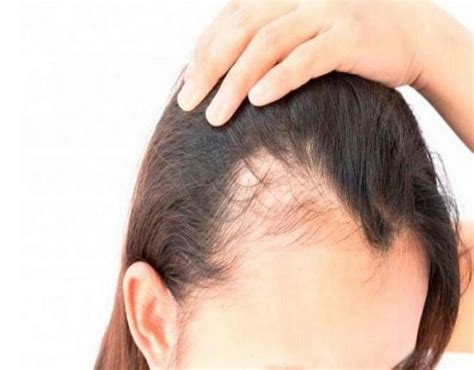 Alopecia Femenina Causas Y Síntomas
