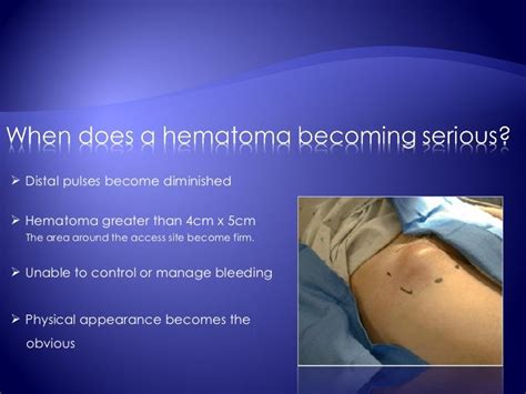 Hematoma Treatment