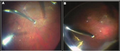 Dye Deposition At The Posterior Hyaloid And Vitreous Base In An Eye