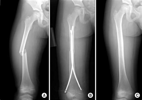 A Comparison Of Overgrowth After Treatment For Pediatric Femoral Shaft