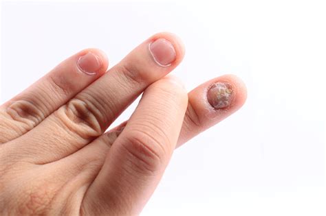 Infección De Hongo En Las Uñas De La Mano Dedo Con Onicomicosis