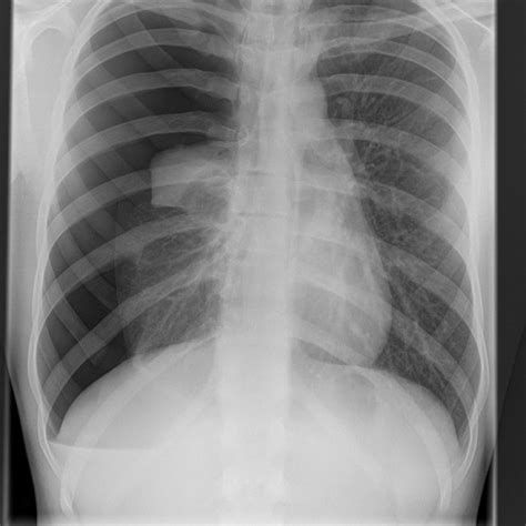 Chest X Ray Showing Large Right Pneumothorax And Small Pleural Effusion Download Scientific