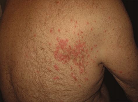 Erythematous Papular Rash On The Upper Back Area—quiz Case Dermatology Jama Dermatology