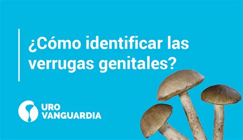 ¿cómo Identificar Las Verrugas Genitales Urovanguardia
