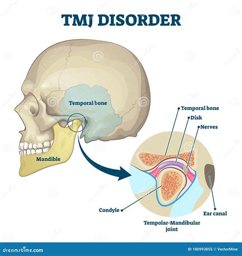 Tmj Disorder Vector Illustration Labeled Jaw Condition Educational Scheme Stock Vector