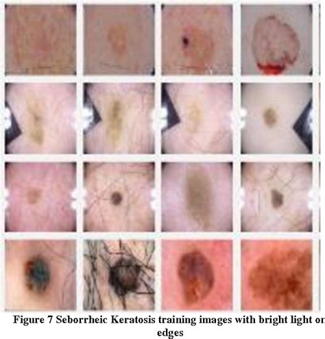 Pdf Isic Skin Lesion Analysis Towards Melanoma Detection Semantic Scholar
