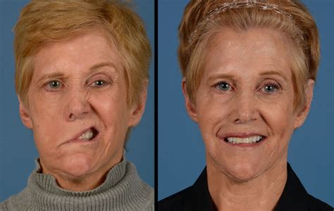 How Susan Got Her Smile Back A Journey Overcoming Facial Paralysis