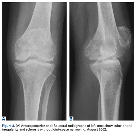 A Rare Case Of Spontaneous Fusion Of The Knee Mdedge Surgery