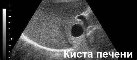 Киста в печени лечение диета Киста печени: причины и лечение заболевания Киста печени: причины и лечение заболевания Киста в печени лечение диета