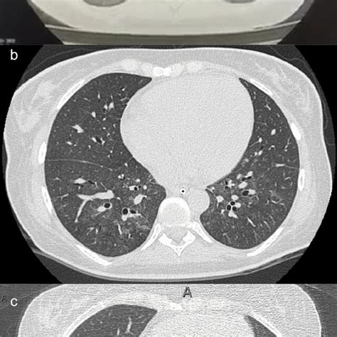 A First Chest Ct Showing Severe Pulmonary Edema B Hypervolemia