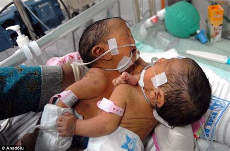 Rare Conjoined Twins Born In Indonesia With Attached Chest Abdomen