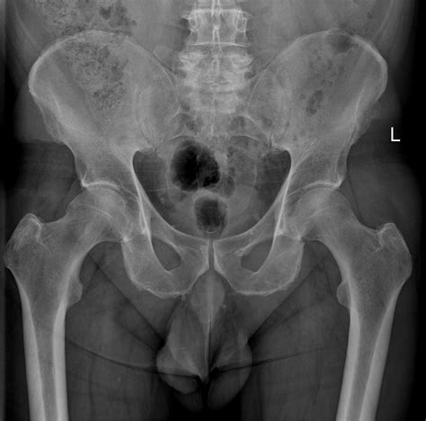 Normal Pelvis And Both Hips Image