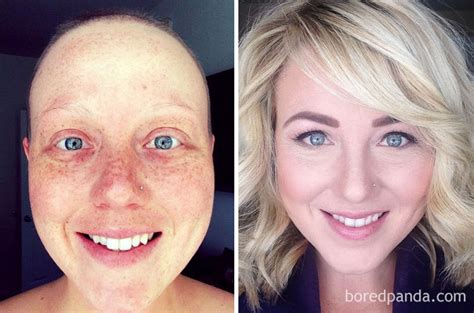 30 Incredible Before And After Pics Of People Who Beat Cancer That Will Make You Appreciate Life