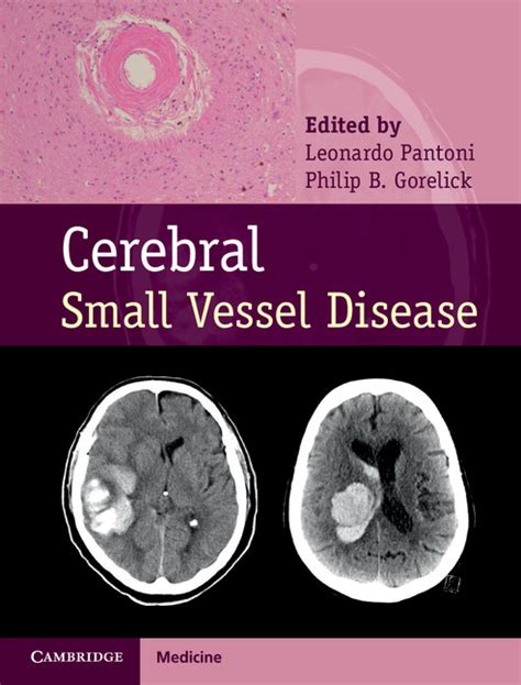 Pathologic Aspects Of The Ischemic Consequences Of Small Vessel Disease