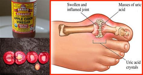 How To Remove Uric Acid Crystals From Your Body Dailyhealthpost