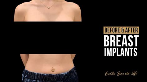 22 Year Old Before After Breast Augmentation 5073 · Rancho Cucamonga · Della Bennett Md Youtube