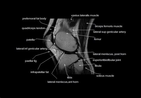 Use the mouse to scroll or the arrows. mri knee anatomy | knee sagittal anatomy | free cross ...