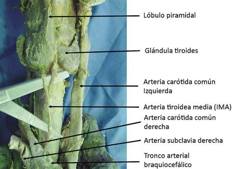 Emergencia De La Arteria Tiroidea Media Ima Desde El Tronco Arterial