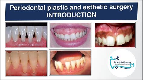 PERIODONTAL PLASTIC AND ESTHETIC SURGERY INTRODUCTION TERMINOLOGIES OBJECTIVES DR ANKITA