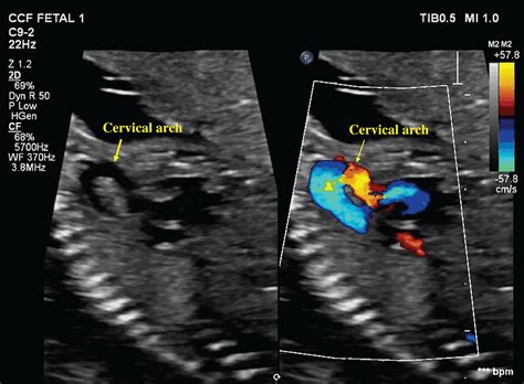 Prenatal Diagnosis Of Rightsided Cervical Aortic Arch With Aberrant