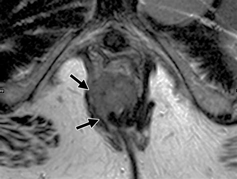 Tumors And Tumorlike Conditions Of The Anal Canal And Perianal Region