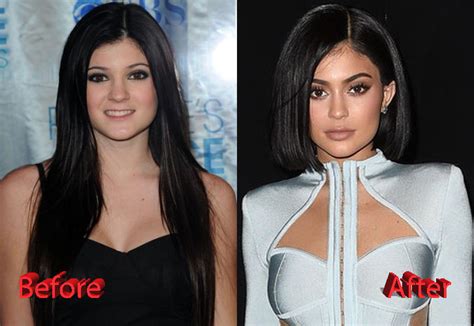 This first pic is from 2009, when kylie was just 12 years old. Kylie Jenner Plastic Surgery Facts, Rumors and News