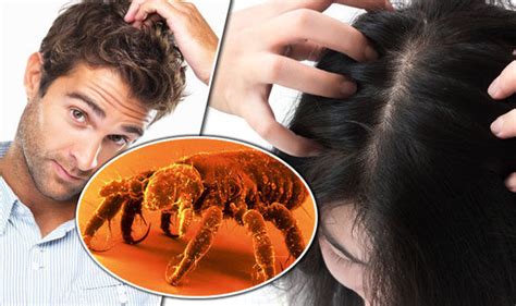 Nits Signs You Have A Head Lice Infestation Include Itchy Scalp