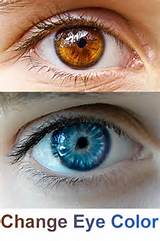 Lasik Eye Surgery Change Eye Color Pictures