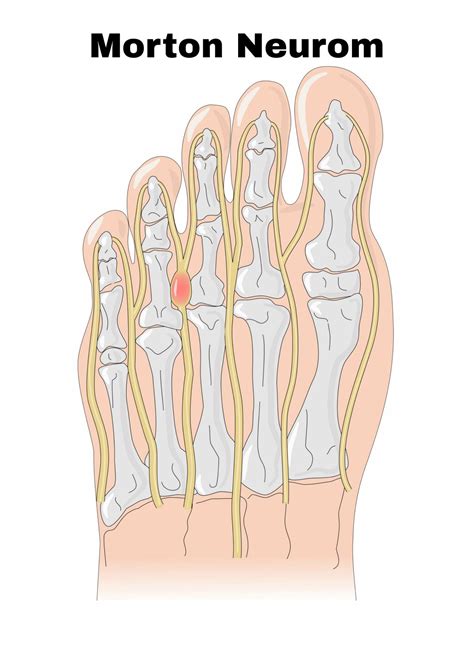 Morton Neurom Ortho Pede Zentrum Für Fuß Und Sprunggelenk