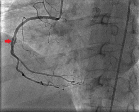 Cureus Successful Management Of Coronary In Stent Restenosis A Case