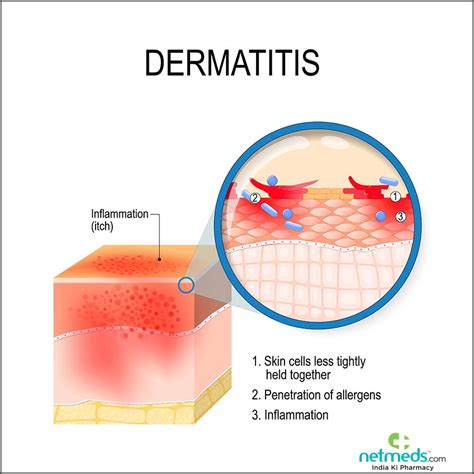 Contact Dermatitis Causes Symptoms And Treatment Netmeds