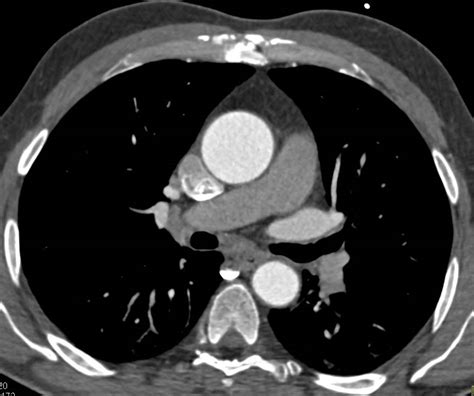 Mildly Dilated Aortic Root And Ascending Aorta Vascular Case Studies
