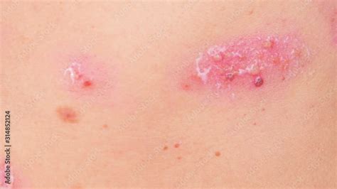 Skin Rash Treatment On Woman Body Shingles Disease Herpes Zoster