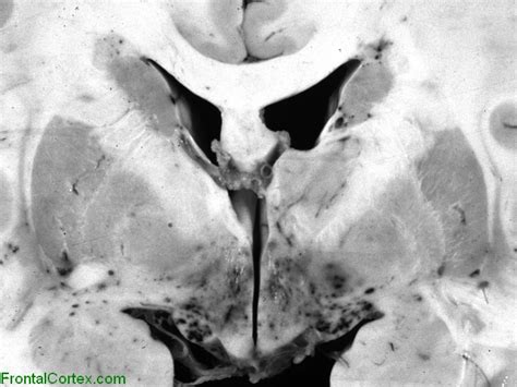 Препарат №63 «гиалиновая хрящевая ткань. Mucormycosis, secondary to Zygomycetes infection, coronal ...