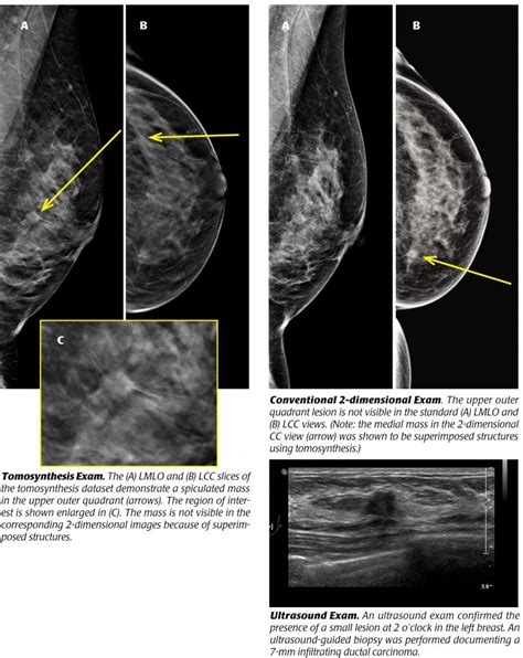 Tomosynthesis Revolutionary Screening For Breast Cancer