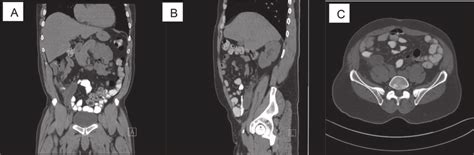 Ct Scan Shows Acute Appendicitis Dilated Fluid Filled Appendix