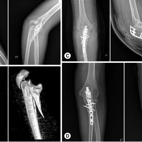 Pdf Treatment Of Olecranon Fractures With Proximal Ulna Comminution