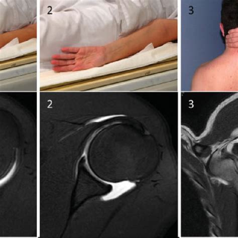 Anterior Glenoid Capsular Attachments From Lateral To Medial I Ii And