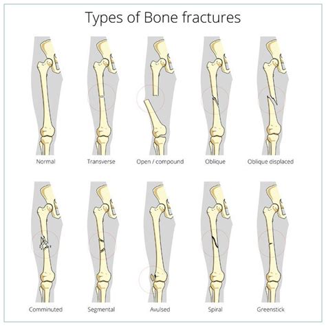 Understanding Bone Fractures Bone Fracture Medical School Essentials