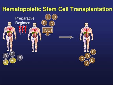 Cellular Immune Therapy With Allogeneic Stem Cell Transplantation