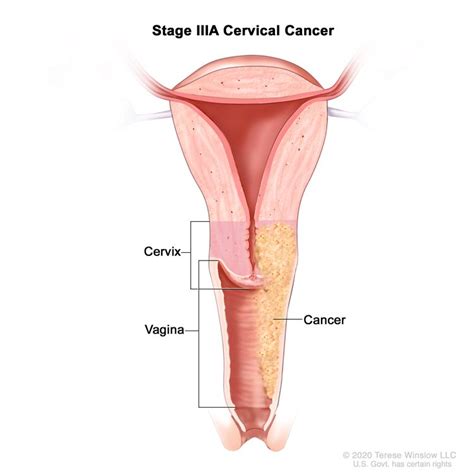 Cervical Cancer Treatment Pdq Patient Version Nci